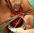 Suture ligated tract