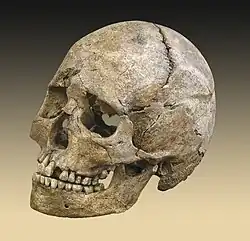 Image 3Skull of the Théviec burial. Female 25 to 35 years died a violent death with numerous skull fractures and bone lesions associated with the impacts of arrow.