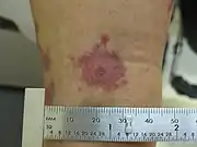 Target lesion