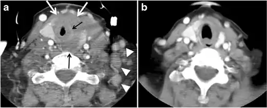 Fig. 11. Thyroid non-Hodgkin's large B-cell lymphoma in a 66-year-old female patient. an Axial enhanced neck CT scan demonstrates left thyroid lobe and isthmus homogeneously hypodense and minimally enhancing mass (white arrows). This lesion invades the prevertebral muscles (black arrows). Note the multiple enlarged level V lymph nodes (white arrowheads). b Post-treatment image shows significant reduction in size and mass effect of the left thyroid infiltrative mass, with almost complete resolution of the left cervical lymphadenopathy.