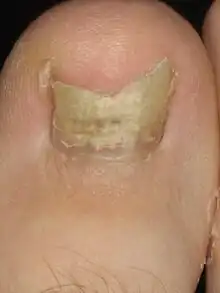 Image 4Onychomycosis (from Fungal infection)