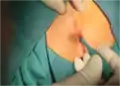 Trephine/biopsy punch minimally invasive surgery for pilonidal disease (1)