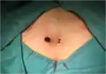 Trephine/biopsy punch minimally invasive surgery for pilonidal disease (2)