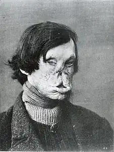 Face severely deformed by leprosy