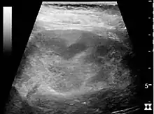 Renal ultrasonograph of acute pyelonephritis with increased cortical echogenicity and blurred delineation of the upper pole.