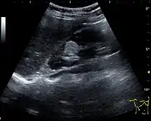 Figure 11. Angiomyolipoma seen as a hyperechoic mass in the upper pole of an adult kidney.