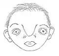 Internasal dysplasia