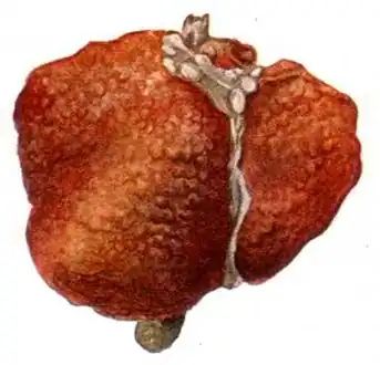 Macronodular cirrhosis