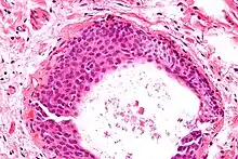 Micrograph of a Walthard cell nest, the entity Brenner tumours are thought to arise from. H&E stain.