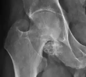 X-ray of synovial chondromatosis.