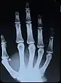 X-Ray image of right hand with no details in the bones at the bottom of the image