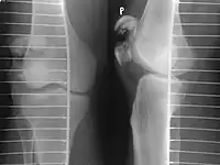 Comminuted fracture of patella