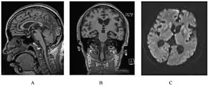 A person with inherited prion disease has cerebellar atrophy. This is highly susceptible for GSS.