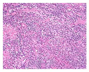 Low power view of IgG4-related prostatitis