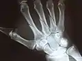 掌骨的多重骨折（aka broken hand）。