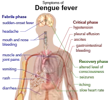 Outline of a human torso with arrows indicating the organs affected in the various stages of dengue fever