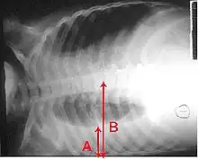 An X-ray showing a chest lying horizontal. The lower black area, which is the right lung, is smaller with a whiter area below it of a pulmonary effusion. There are red arrows marking the size of these.